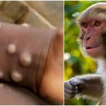 اعلام اولین مورد ابتلا به آبله میمون در لبنان