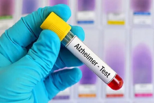 روش‌ های جدید تشخیص آلزایمر