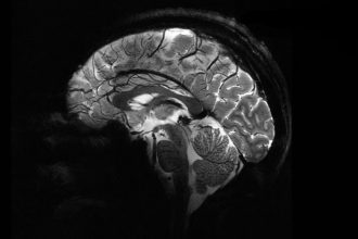 قدرتمندترین دستگاه MRI جهان اولین اسکن مغزی خیره‌کننده را ثبت کرد